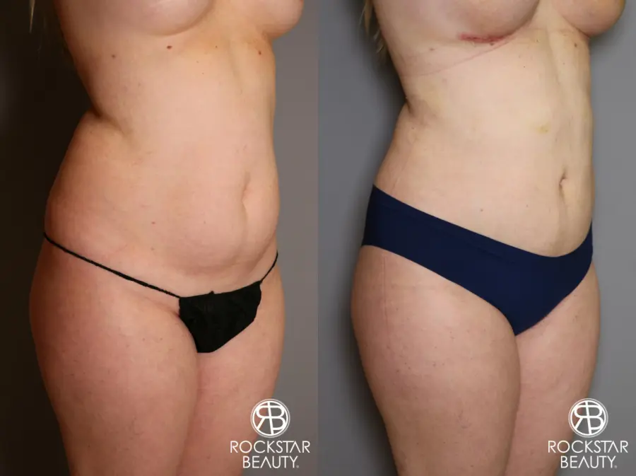 Liposuction: Patient 11 - Before and After 2