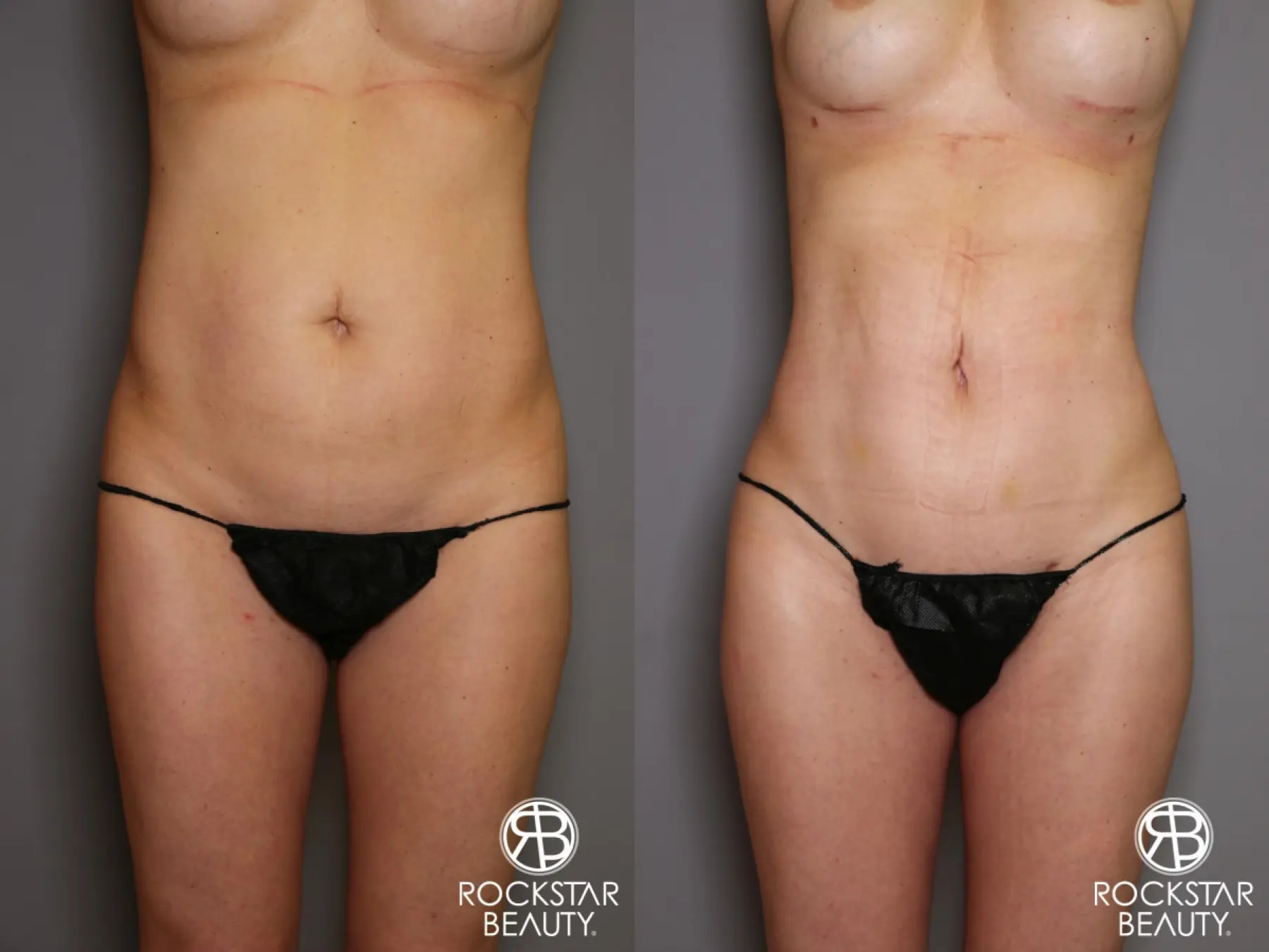 Liposuction: Patient 13 - Before and After 1