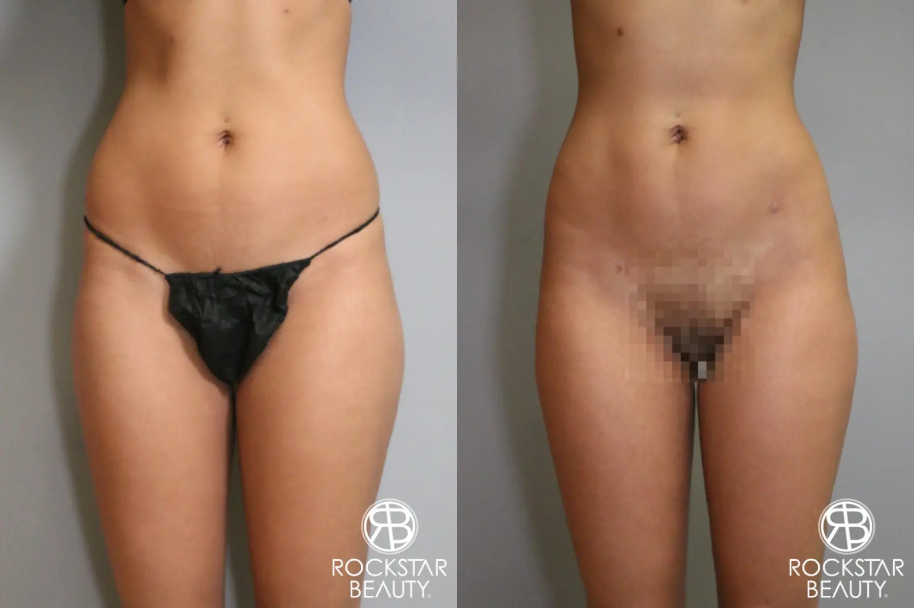 Liposuction: Patient 6 - Before and After 2