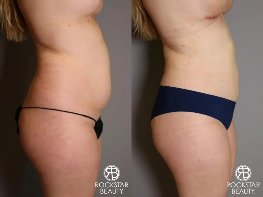 Liposuction: Patient 11 - Before and After 3