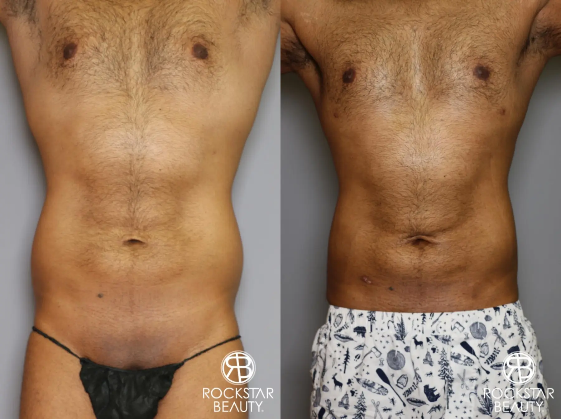 Liposuction: Patient 16 - Before and After 5