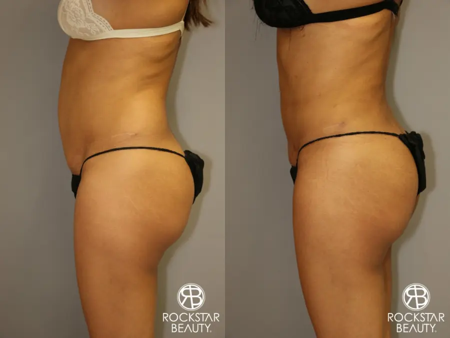 Liposuction: Patient 3 - Before and After 5