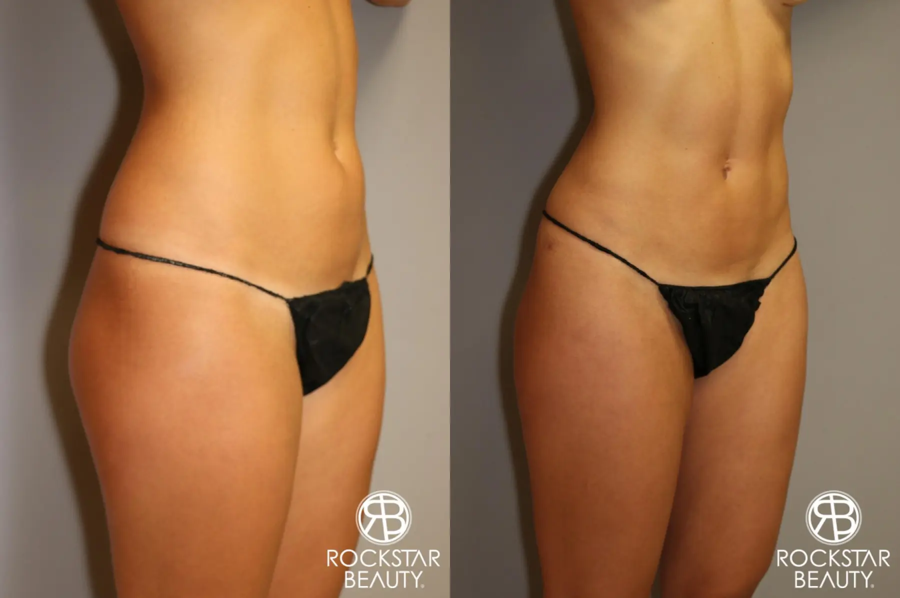 Liposuction: Patient 4 - Before and After 1