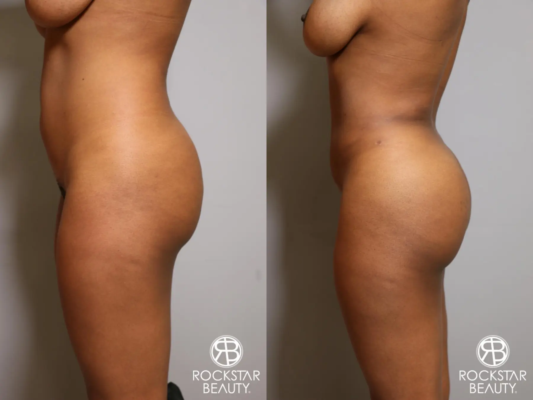 Liposuction: Patient 18 - Before and After 4