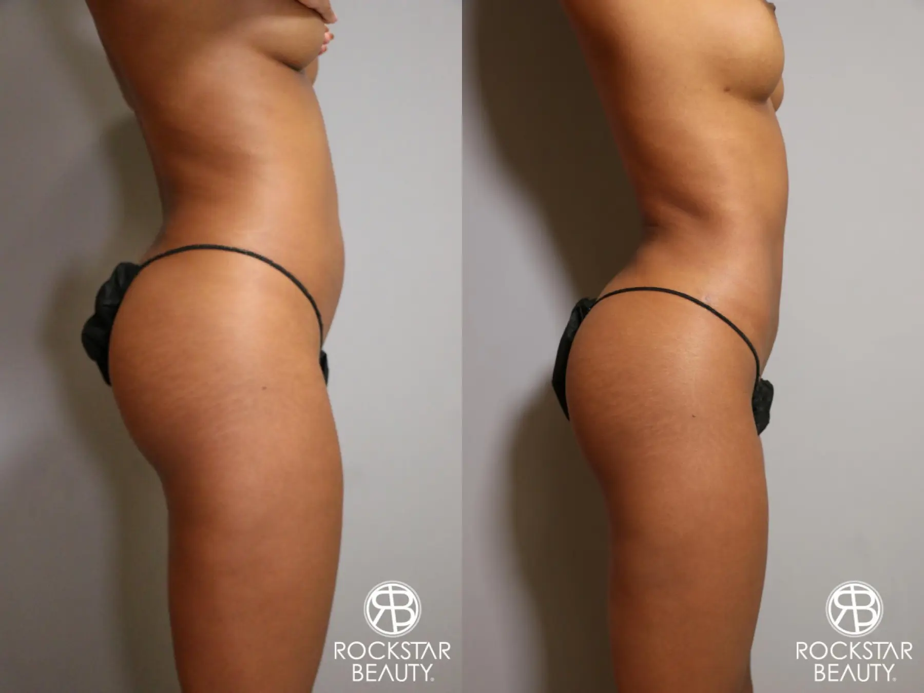 Liposuction: Patient 1 - Before and After 3