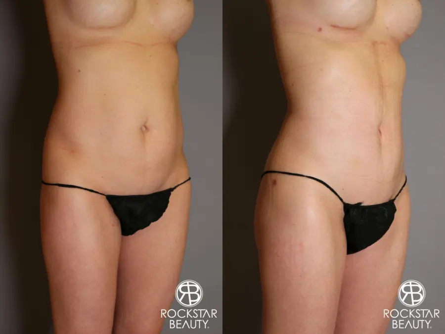Liposuction: Patient 13 - Before and After 2