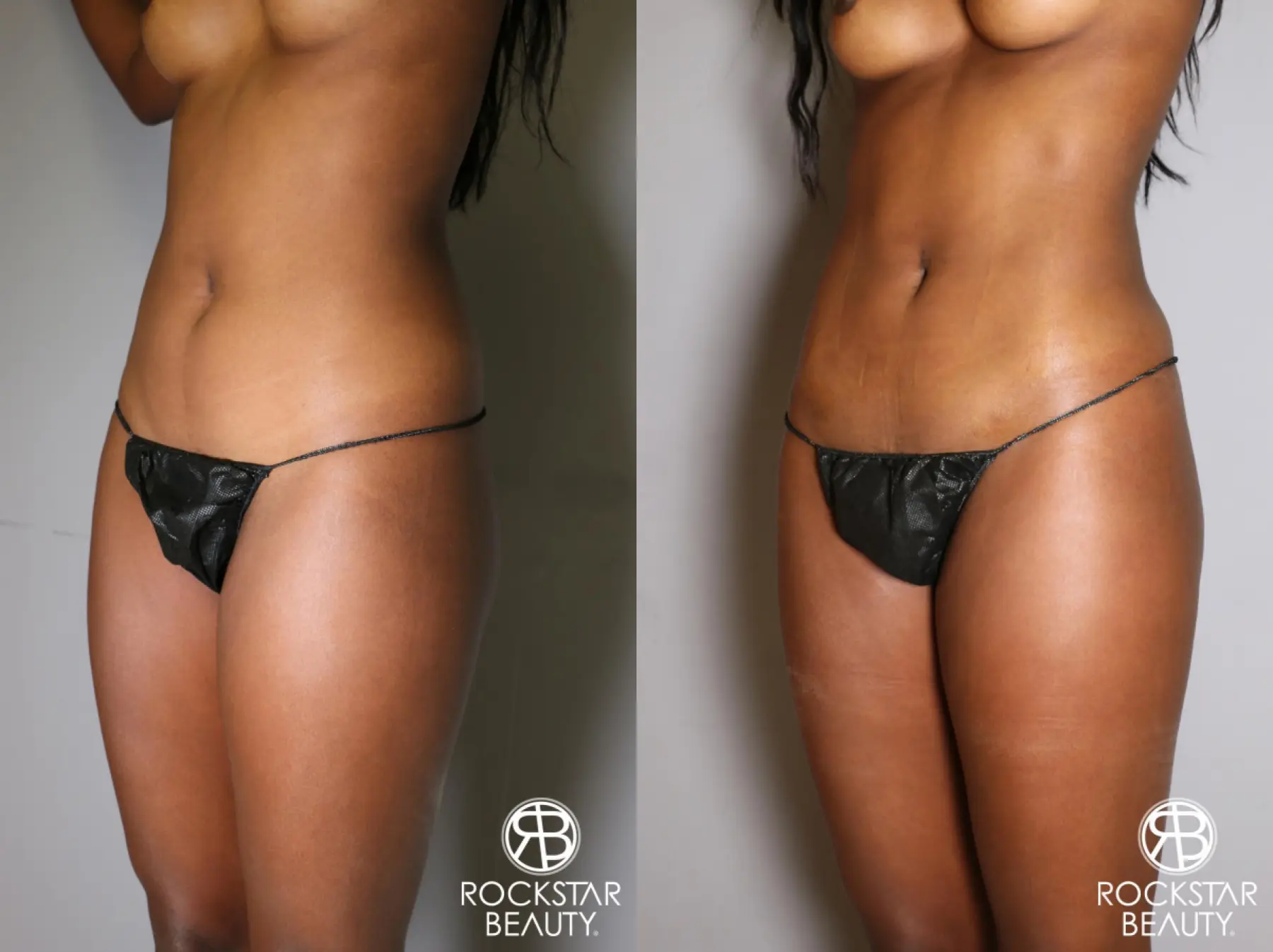 Liposuction: Patient 19 - Before and After 2