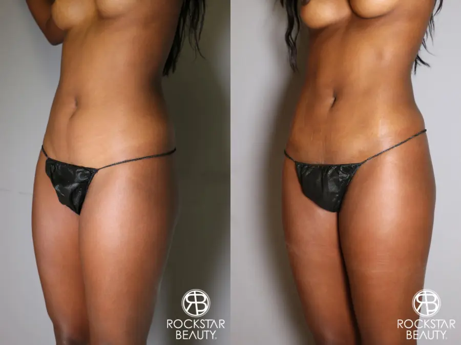 Liposuction: Patient 19 - Before and After 2