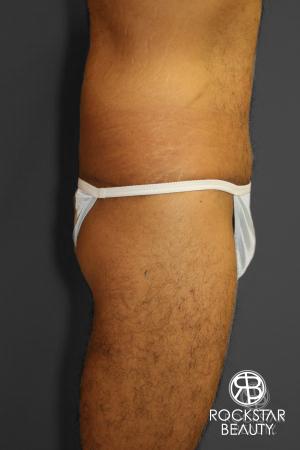 Body Lift: Patient 1 - After Image 3
