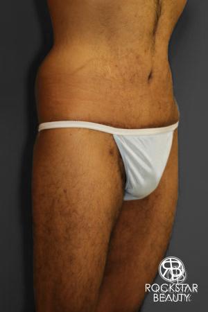 Body Lift: Patient 1 - After Image 2