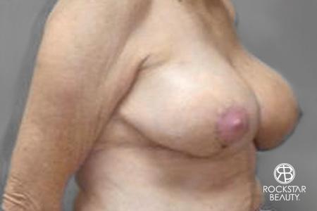 Breast Reduction: Patient 2 - After 2