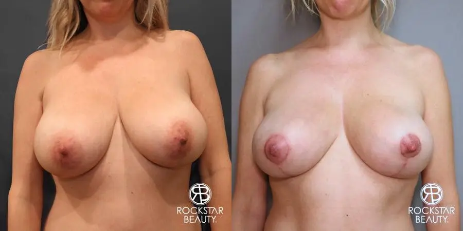 Mastopexy: Patient 1 - Before and After 1