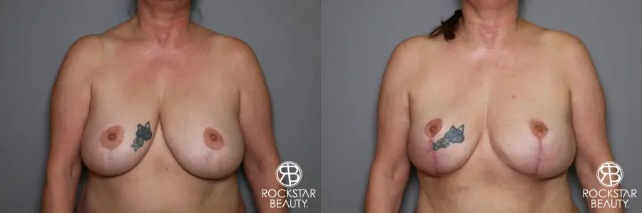Mastopexy: Patient 2 - Before and After 1