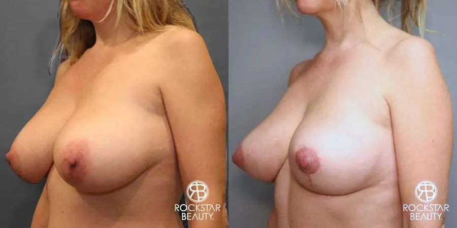 Mastopexy: Patient 1 - Before and After 4