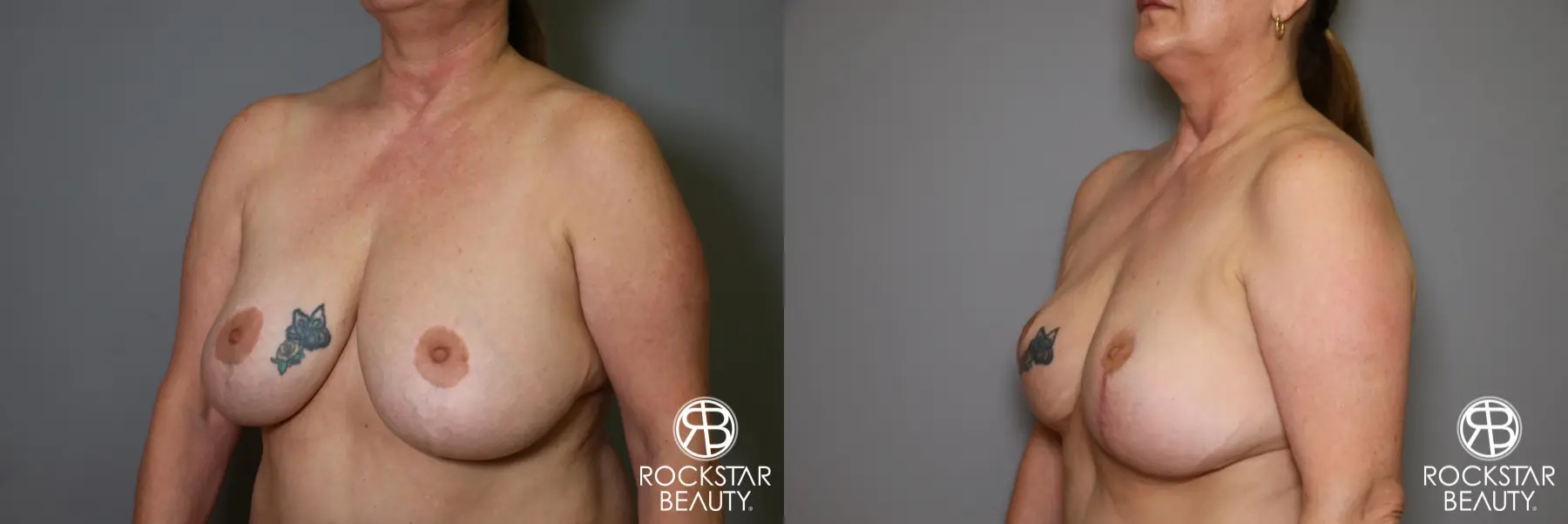 Mastopexy: Patient 2 - Before and After 3