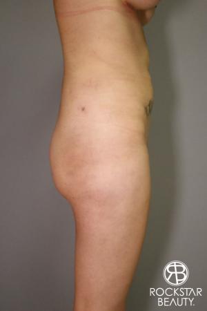 Liposuction: Patient 2 - After Image 2