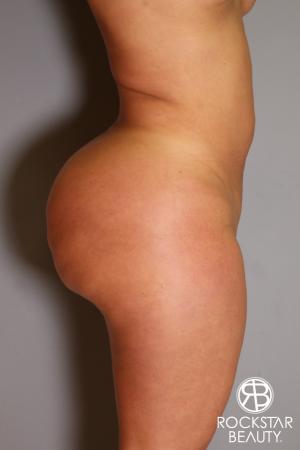 Brazilian Butt Lift: Patient 14 - Before and After Image 3