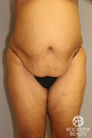 Tummy Tuck: Patient 3 - Before Image 1