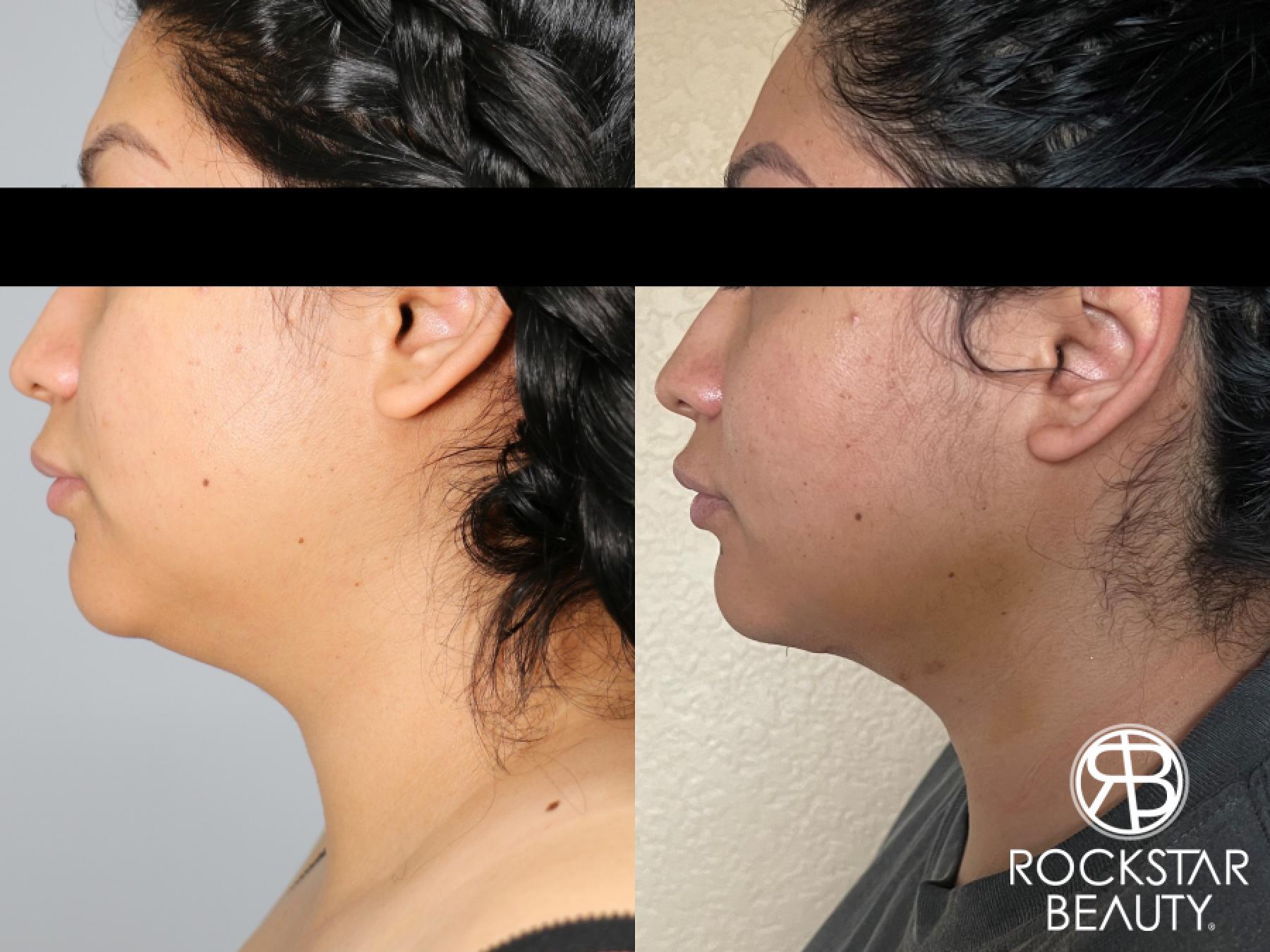 Liposuction Of The Neck: Patient 79 - Before and After 1