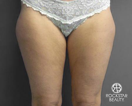 SmartLipo®: Patient 4 - Before Image 1