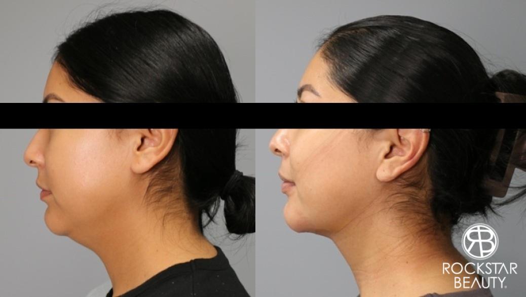 Liposuction Of The Neck: Patient 6 - Before and After  
