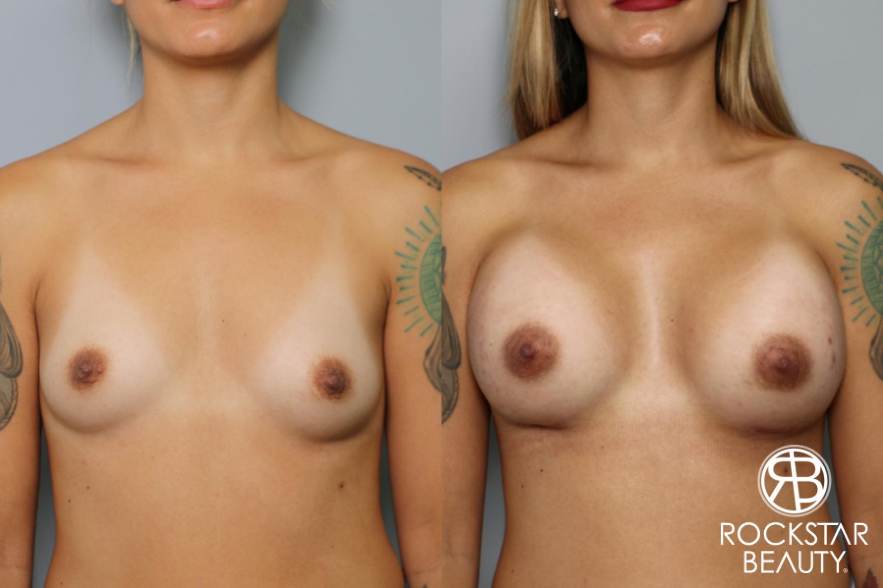 Breast Augmentation: Patient 32 - Before and After 1