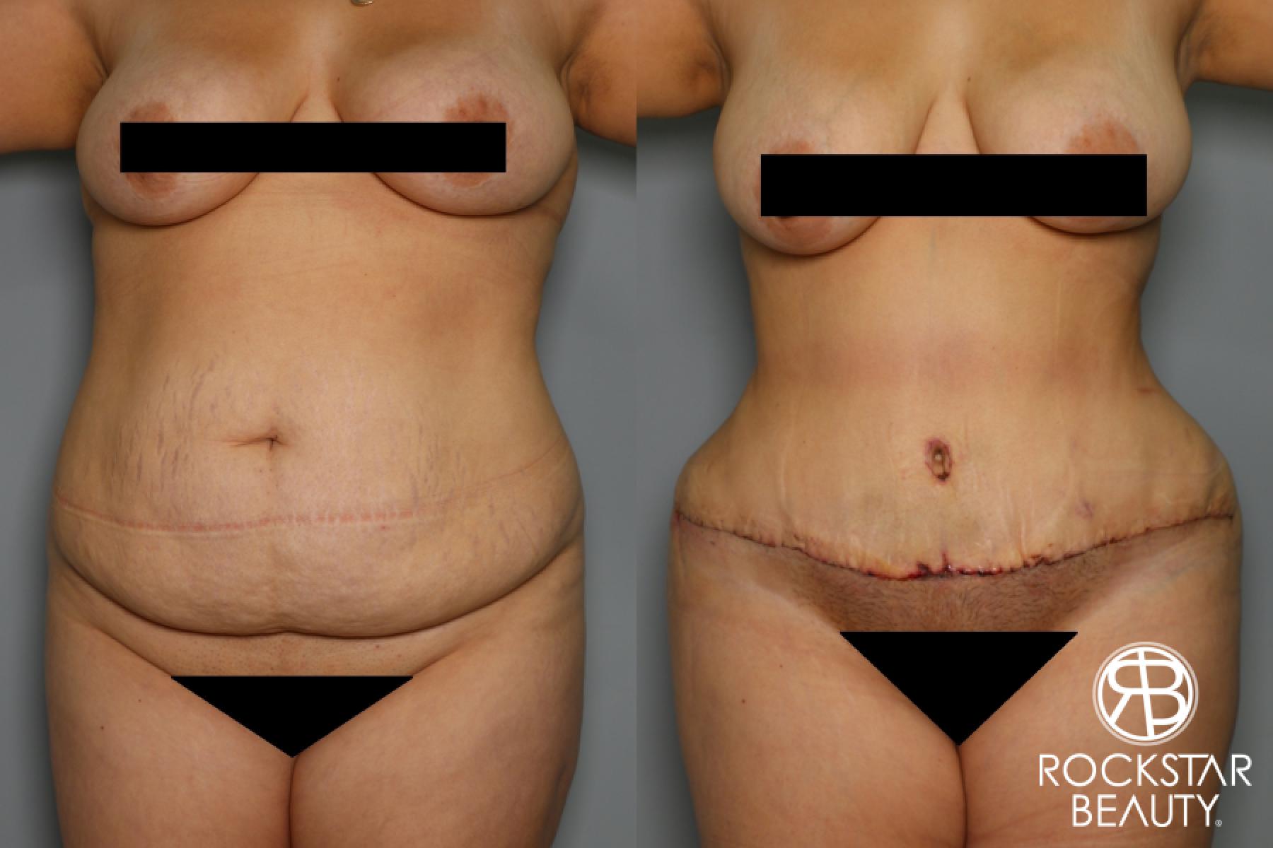 Tummy Tuck: Patient 18 - Before and After 1
