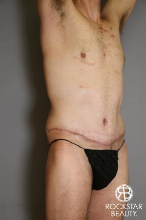 Tummy Tuck: Patient 11 - After Image 2