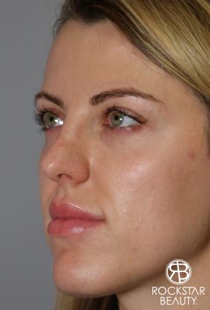 Rhinoplasty: Patient 1 - After Image 4
