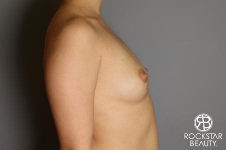 Breast Augmentation: Patient 16 - Before and After Image 5