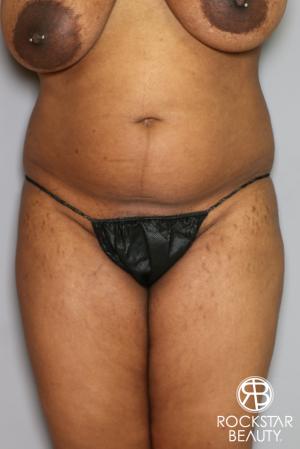 Brazilian Butt Lift: Patient 13 - Before and After Image 4