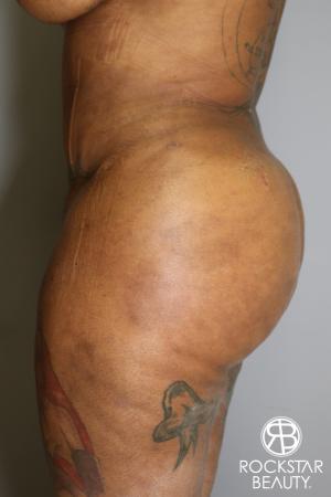 Brazilian Butt Lift: Patient 15 - After Image 4