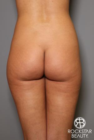 Brazilian Butt Lift: Patient 5 - Before Image 1
