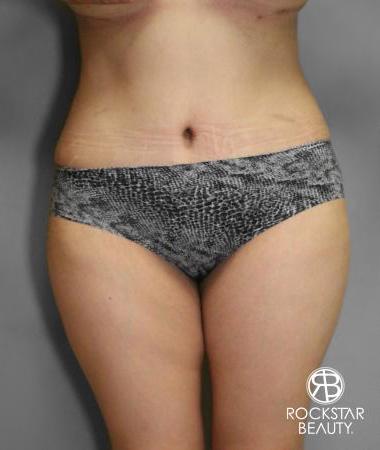 Tummy Tuck: Patient 10 - After 1