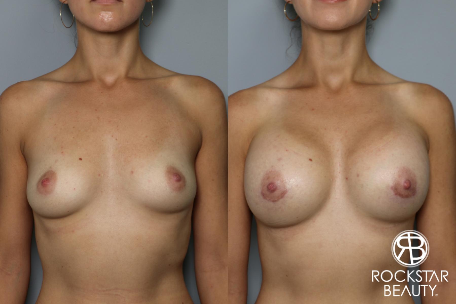 Breast Augmentation: Patient 34 - Before and After 1
