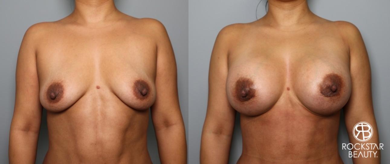 Breast Augmentation: Patient 55 - Before and After 1