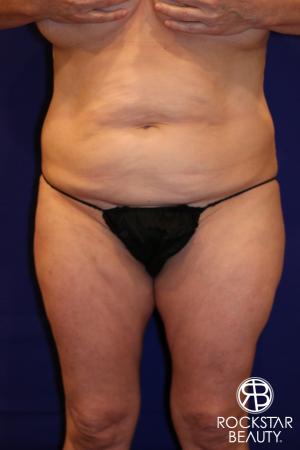 Tummy Tuck: Patient 12 - Before Image 1