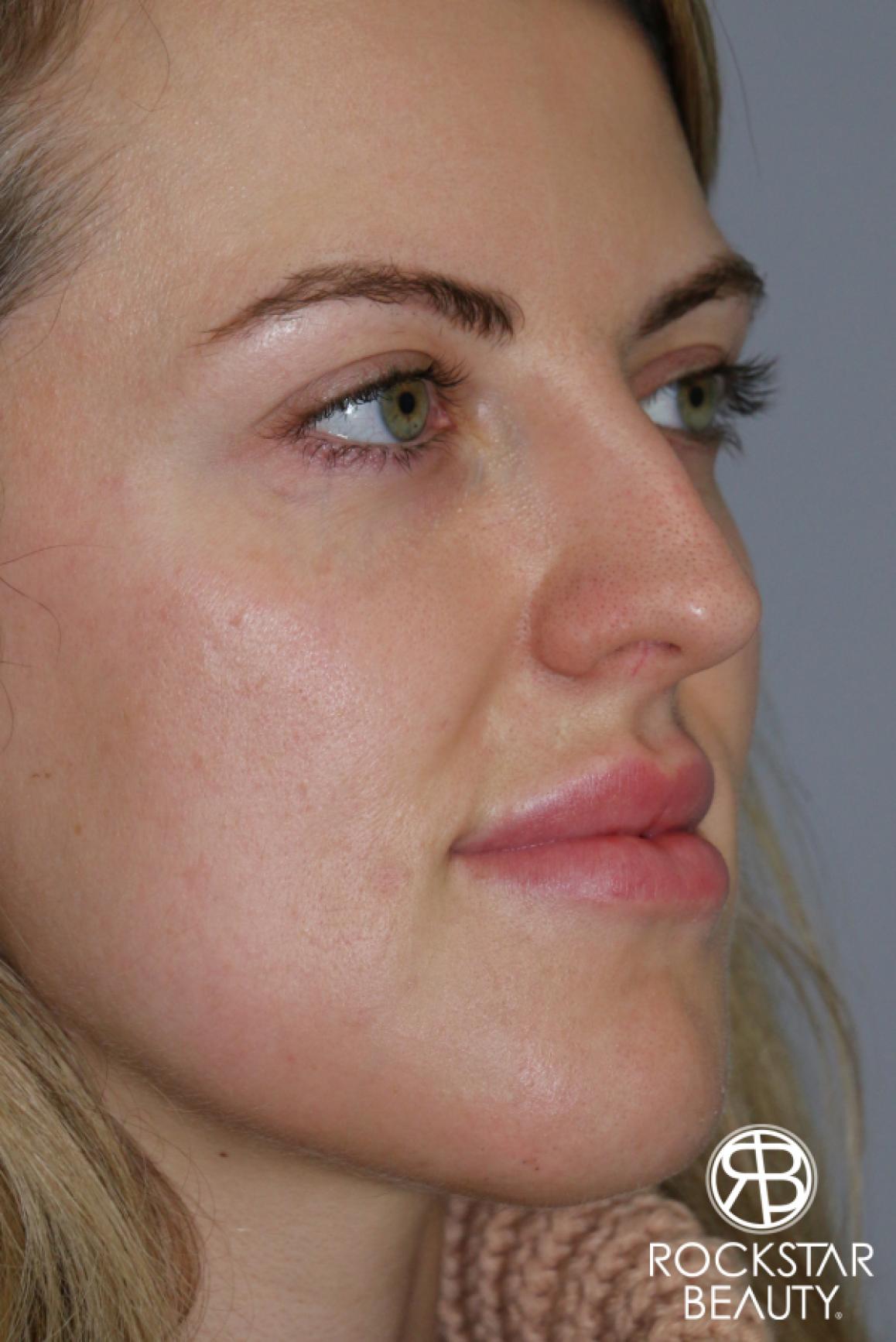 Rhinoplasty: Patient 1 - Before 