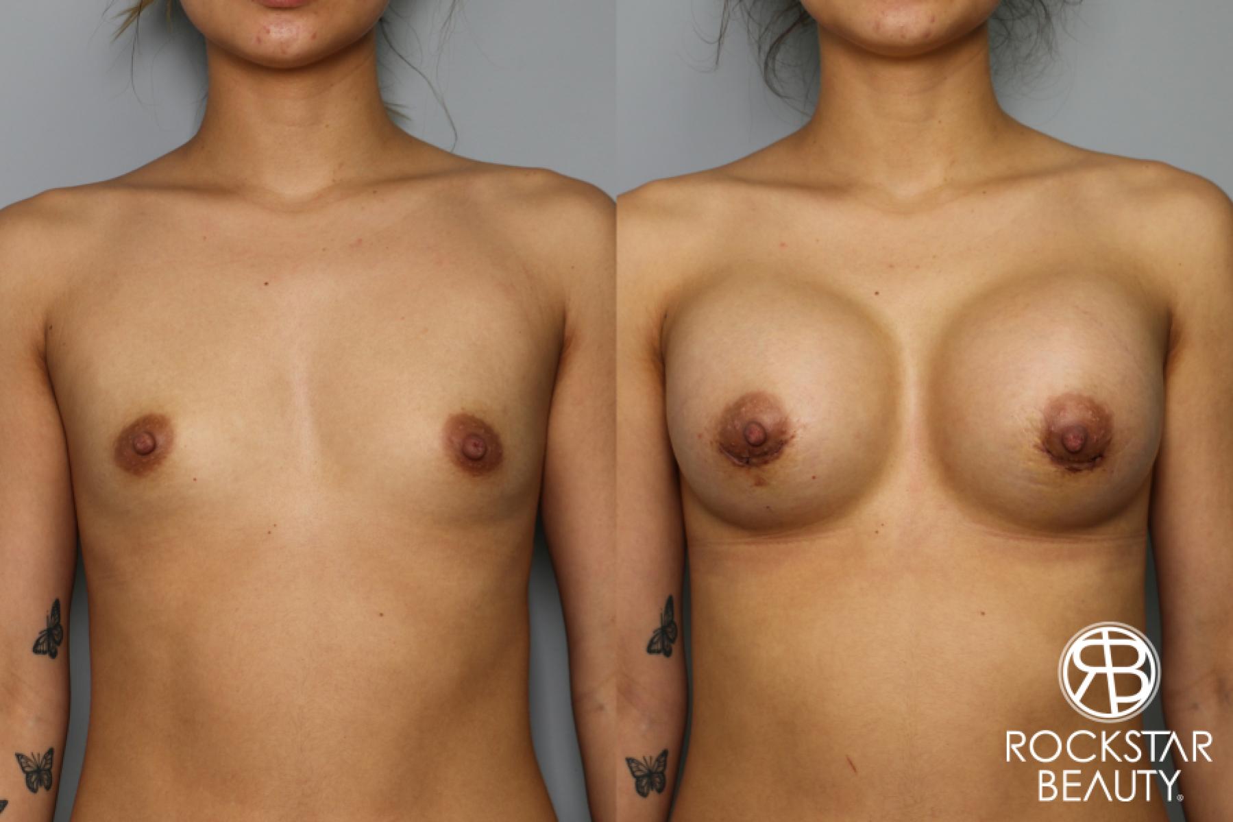 Breast Augmentation: Patient 28 - Before and After 1