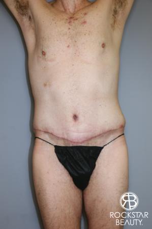 Tummy Tuck: Patient 11 - After Image 1