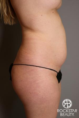 Liposuction: Patient 11 - Before and After Image 3