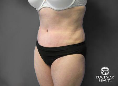 Tummy Tuck: Patient 6 - After 3