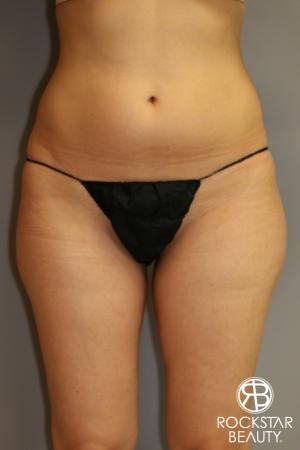 SmartLipo®: Patient 1 - Before Image 1