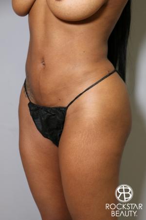 Brazilian Butt Lift: Patient 10 - After Image 5