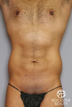 Liposuction: Patient 16 - Before and After Image 5