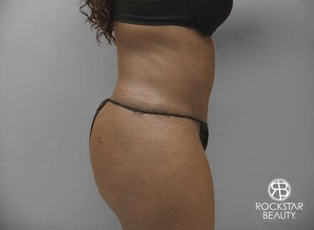 Tummy Tuck: Patient 7 - After 2