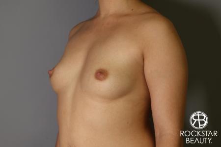 Breast Augmentation: Patient 16 - Before Image 2