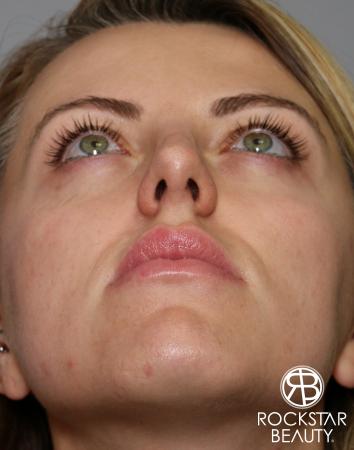Rhinoplasty: Patient 1 - After Image 5