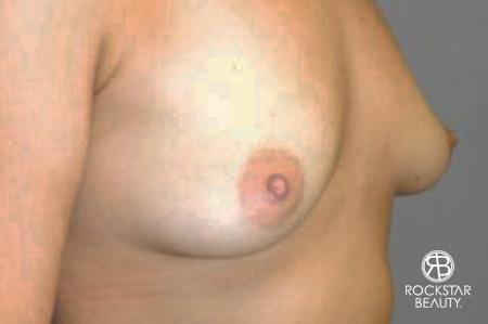 Breast Augmentation - Fat: Patient 1 - Before Image 2