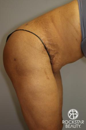 Tummy Tuck: Patient 3 - After Image 4